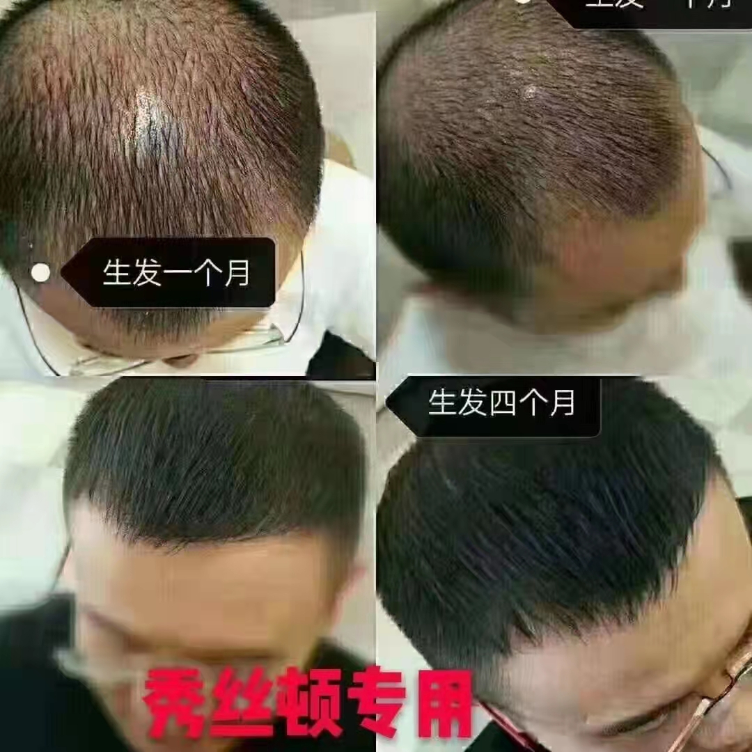 秀丝顿头疗改善头皮环境防脱生发