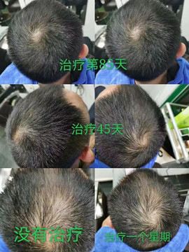 秀丝顿植物养发馆专业改善头皮各种问题