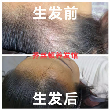 秀丝顿植物养发还能抑制白发增多，平衡油脂减少脱发。