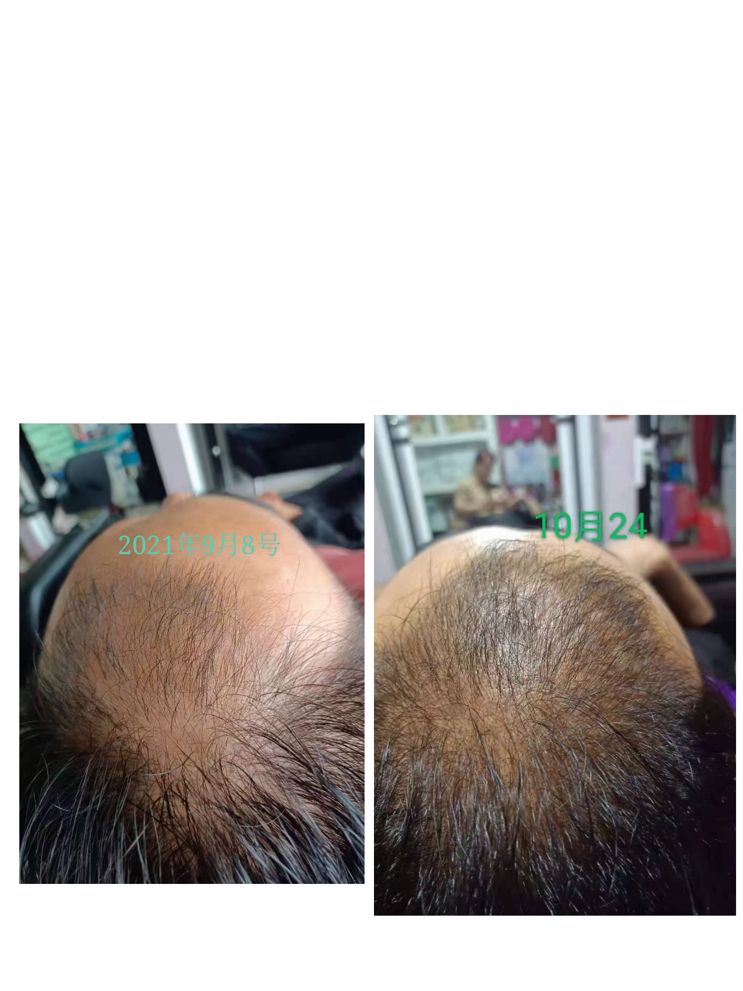 秀丝顿植物养发头疗可以改善气血，加快头部气血循环