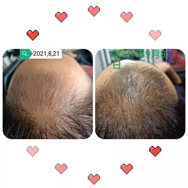 秀丝顿植物养发防脱育发，采用天然植物成分，针对头发问题进行根源性解决