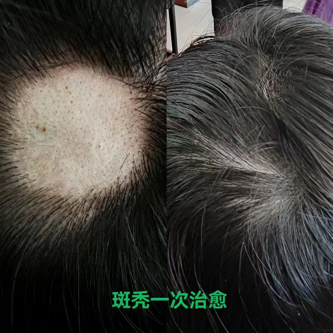 秀丝顿头疗养发馆1000多家店面改善脱发白发