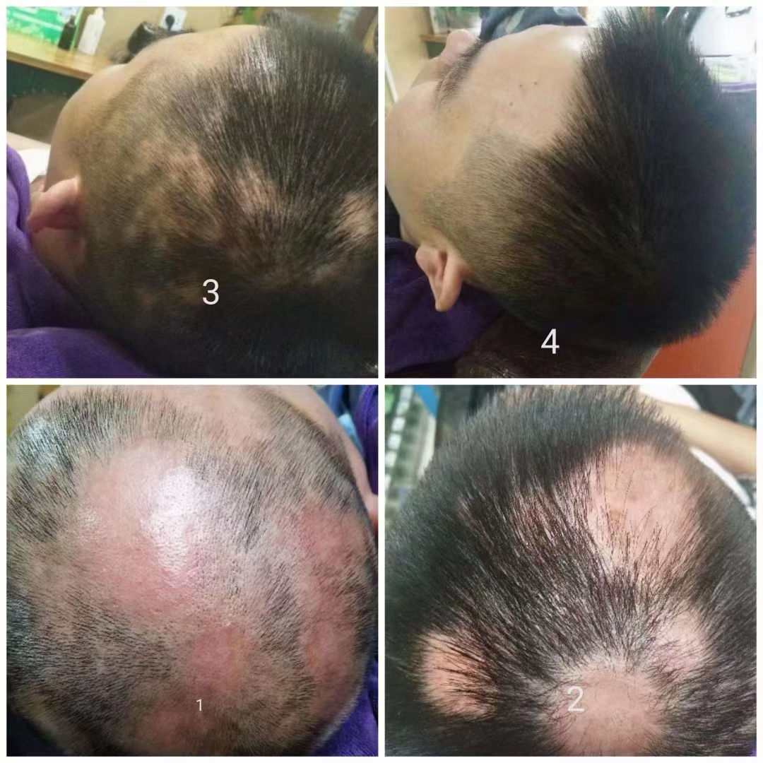 ��˿��ֲ�������� ͷ�����ƾ�����ͷ����������Ħͷ���ﵽԤ�������Ƽ���Ŀ��һ�ַ���