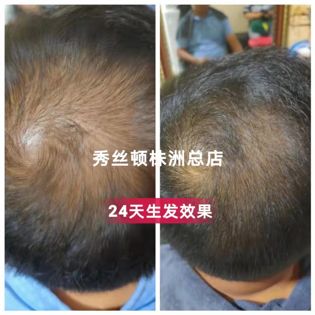 ��˿��ֲ����ͷ�ͣ������ܹ����ͷƤ���⣬���ܹ�����ͷ������������ӵ�н���������ͷ��