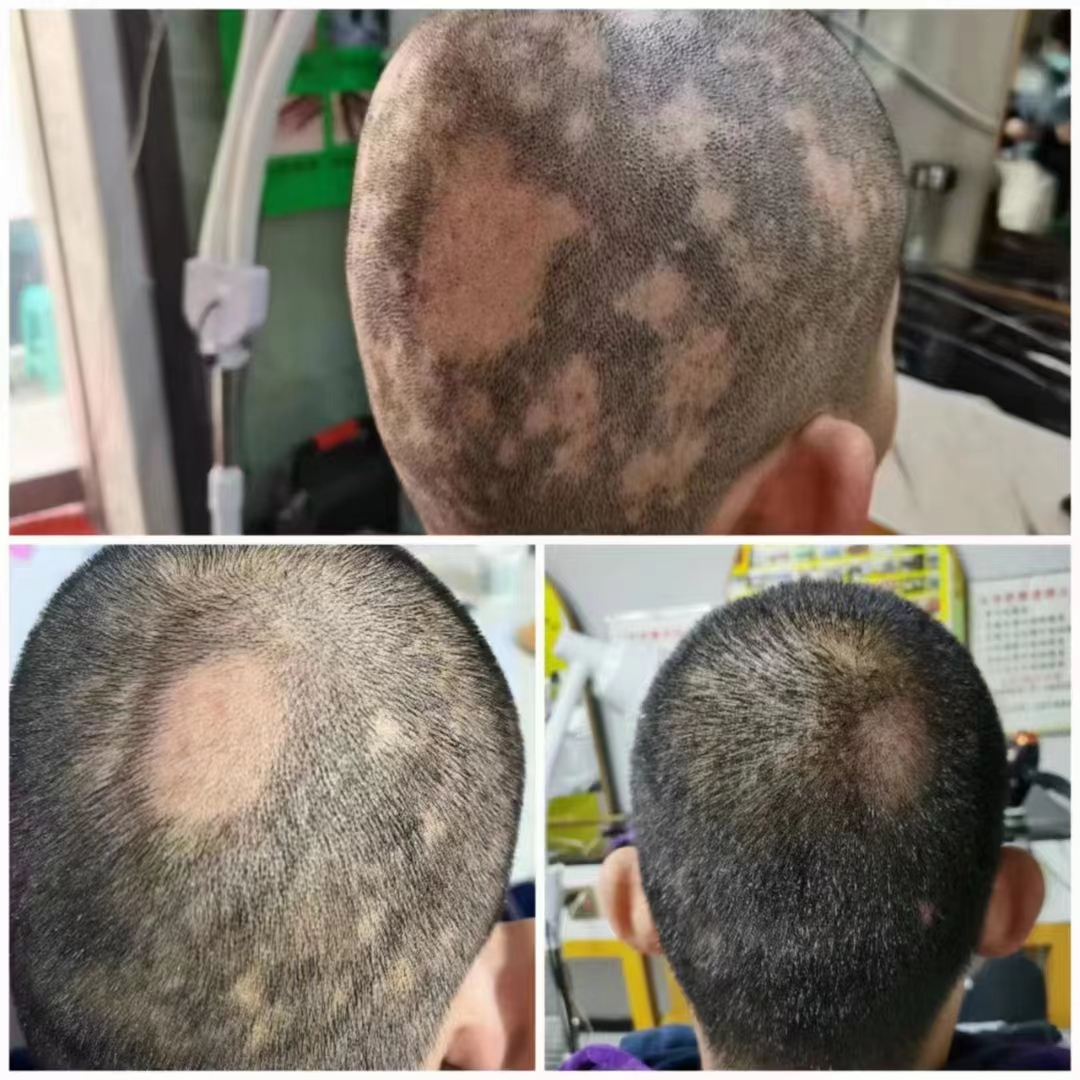 ��˿��ֲ������������Ȼ��ֲ����ȡ�ͨ����ѧ��ȣ�Ϊͷ���ṩȫ���Ӫ������ǿͷƤ�������ٽ�ͷ������