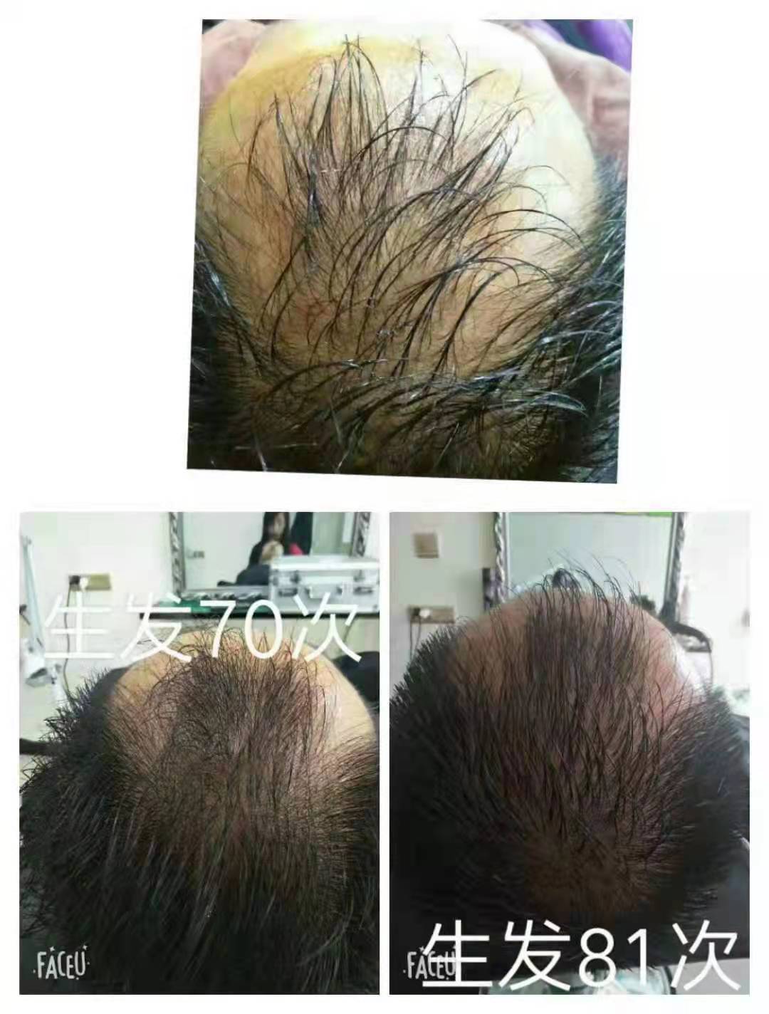 ��˿��ֲ�������ݵ���ҩ�Ƽ������˶�����Ȼֲ����ȡ��ܹ�����ͷƤ���̼�ë�ң����ӷ�˿�����ֹ�Ӧ
