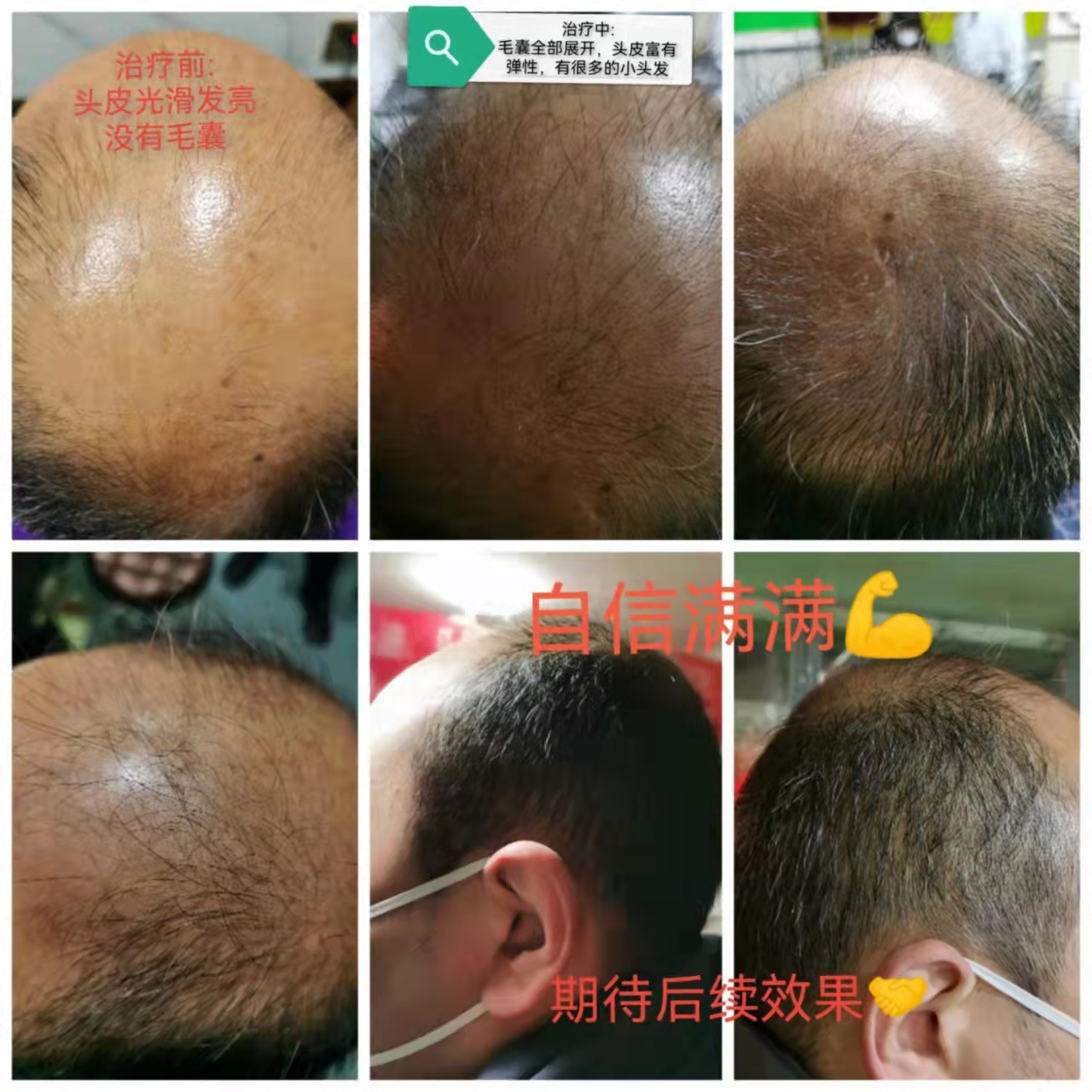 ��˿��ֲ�������������ܹ�����ͷƤ���ٽ�ͷ�����������ܹ���Ч�ؽ��׷�����